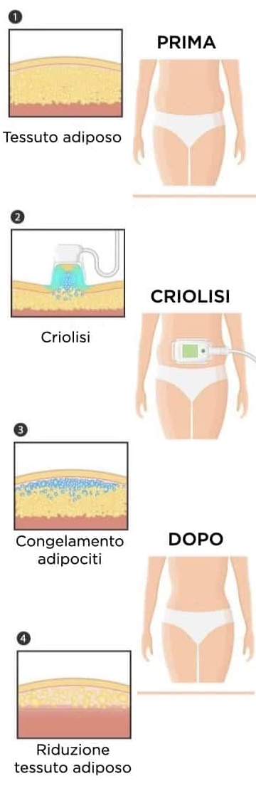 CRYOLIPOSCULTP- CRIOLIPOLISI DIMAGRIMENTO CORPOLIBEROCENTROMEDICO